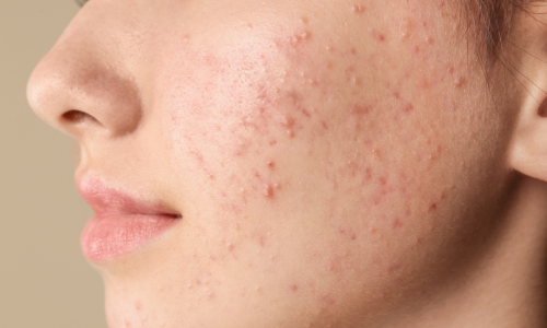 Hormonal Breakouts